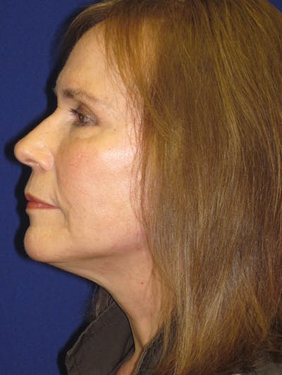 Facelift/Mini-Facelift Before & After Gallery - Patient 4890484 - Image 6