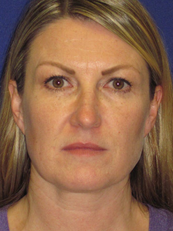 Facelift/Mini-Facelift Before & After Gallery - Patient 4890486 - Image 1