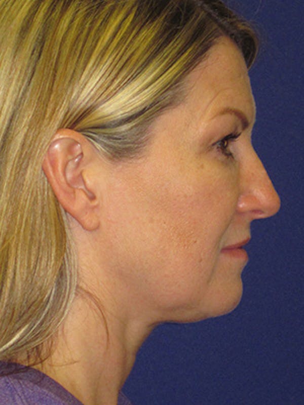 Facelift/Mini-Facelift Before & After Gallery - Patient 4890486 - Image 3