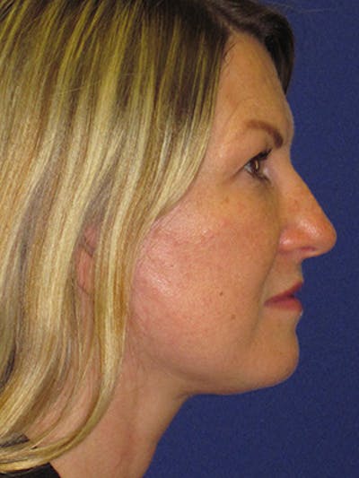 Facelift/Mini-Facelift Before & After Gallery - Patient 4890486 - Image 4