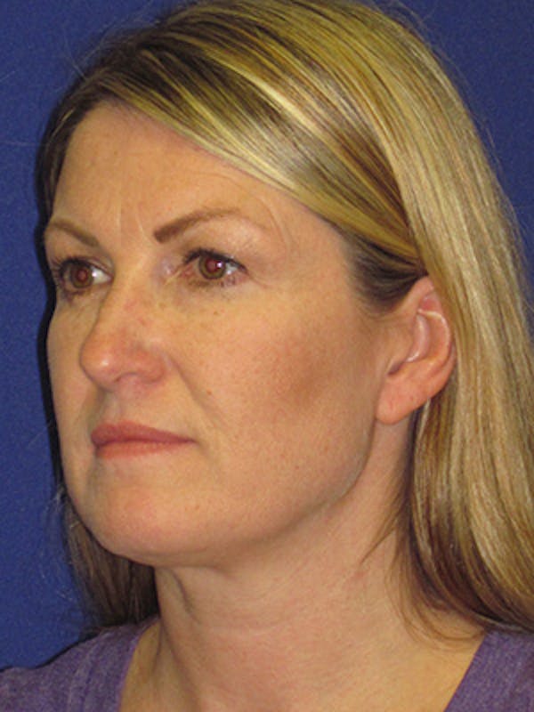 Facelift/Mini-Facelift Before & After Gallery - Patient 4890486 - Image 5