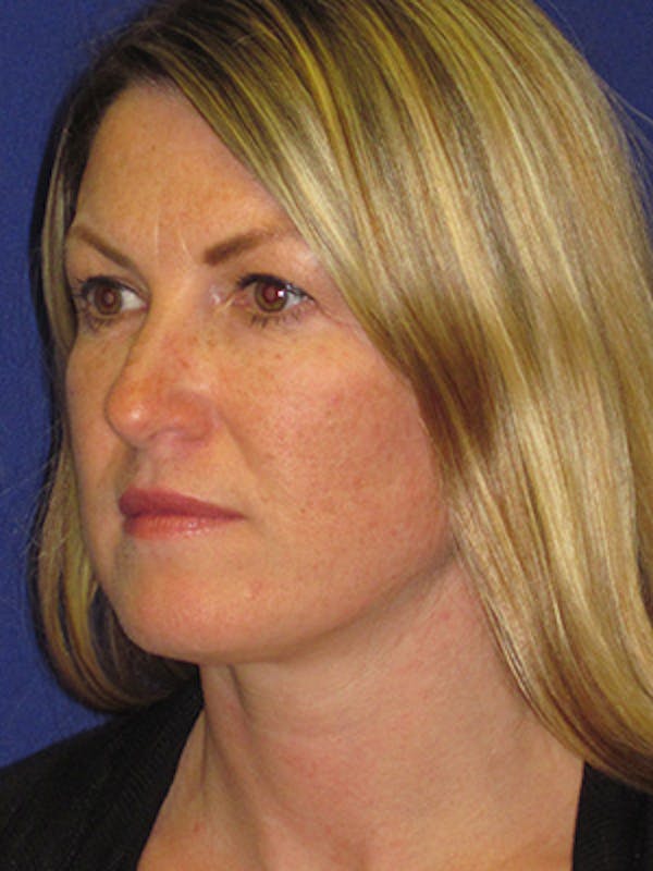 Facelift/Mini-Facelift Before & After Gallery - Patient 4890486 - Image 6