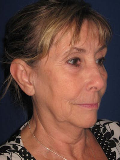 Facelift/Mini-Facelift Before & After Gallery - Patient 4890487 - Image 1