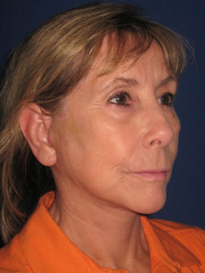 Facelift/Mini-Facelift Before & After Gallery - Patient 4890487 - Image 2