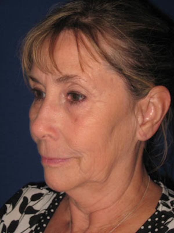Facelift/Mini-Facelift Before & After Gallery - Patient 4890487 - Image 3