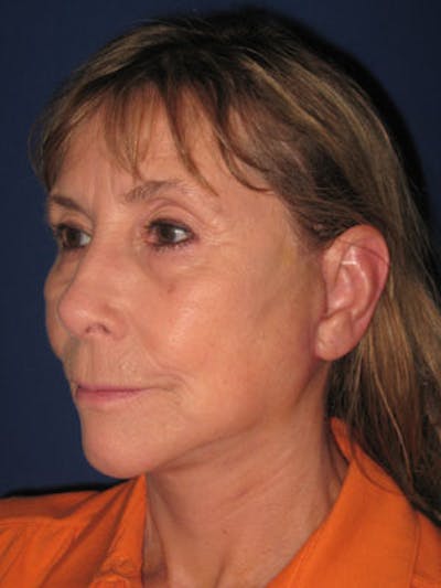 Facelift/Mini-Facelift Before & After Gallery - Patient 4890487 - Image 4