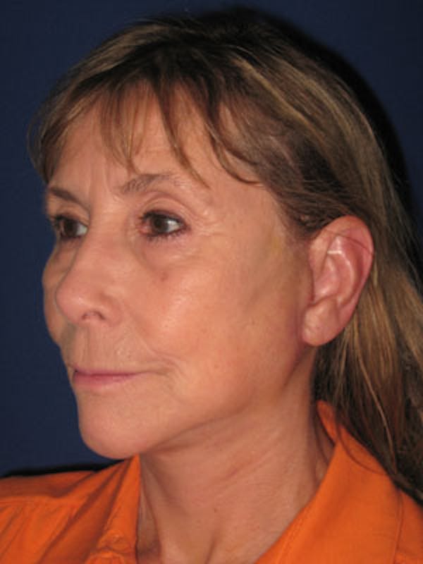 Facelift/Mini-Facelift Before & After Gallery - Patient 4890487 - Image 4