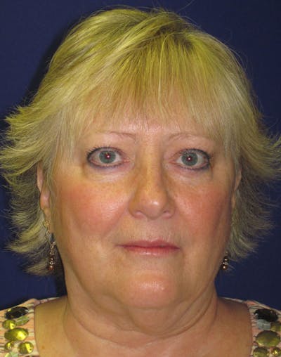 Facelift/Mini-Facelift Before & After Gallery - Patient 4890498 - Image 1