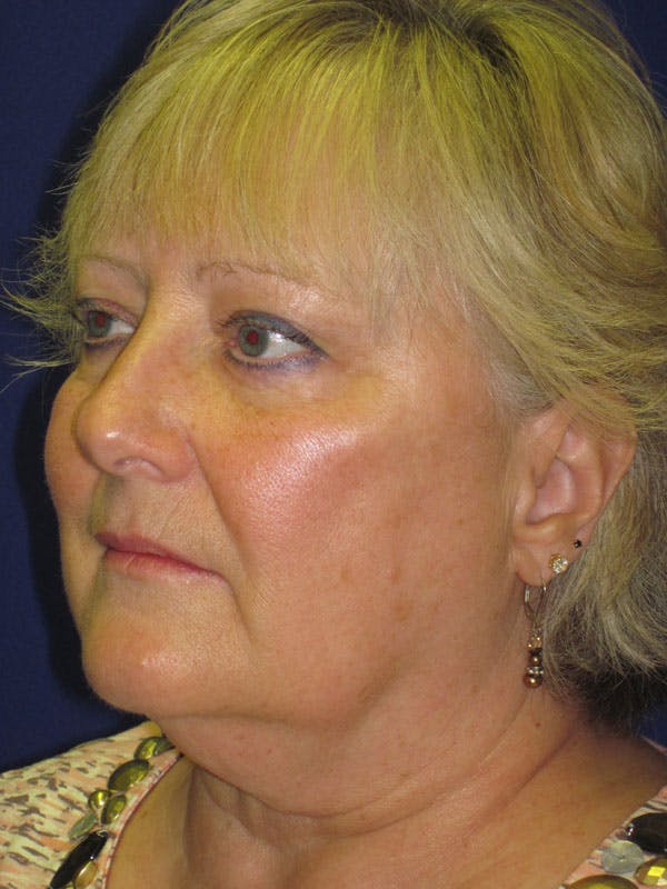 Facelift/Mini-Facelift Before & After Gallery - Patient 4890498 - Image 3