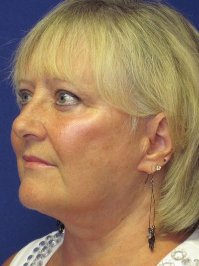 Facelift/Mini-Facelift Before & After Gallery - Patient 4890498 - Image 4