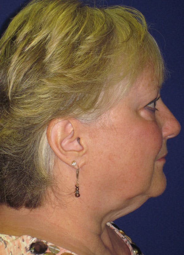 Facelift/Mini-Facelift Before & After Gallery - Patient 4890498 - Image 5