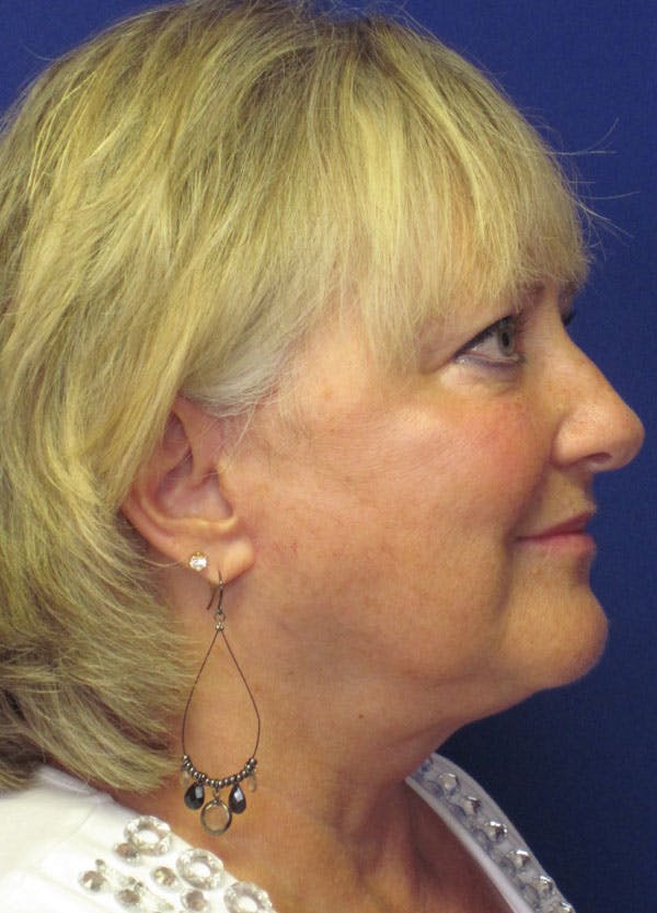Facelift/Mini-Facelift Before & After Gallery - Patient 4890498 - Image 6