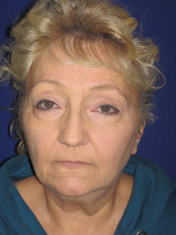 Facelift/Mini-Facelift Before & After Gallery - Patient 4890506 - Image 1