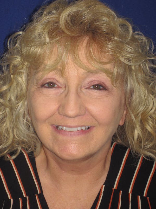 Facelift/Mini-Facelift Before & After Gallery - Patient 4890506 - Image 2