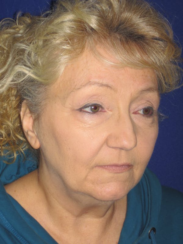 Facelift/Mini-Facelift Before & After Gallery - Patient 4890506 - Image 3