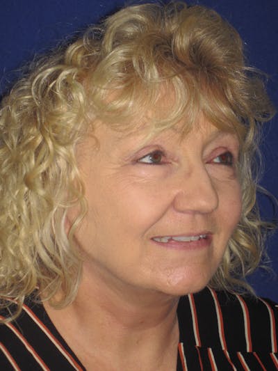 Facelift/Mini-Facelift Before & After Gallery - Patient 4890506 - Image 4
