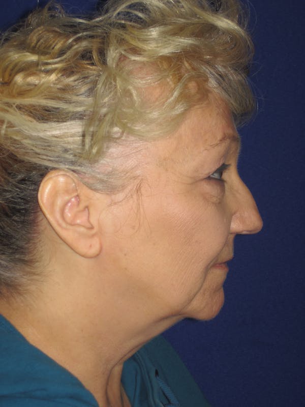 Facelift/Mini-Facelift Before & After Gallery - Patient 4890506 - Image 5