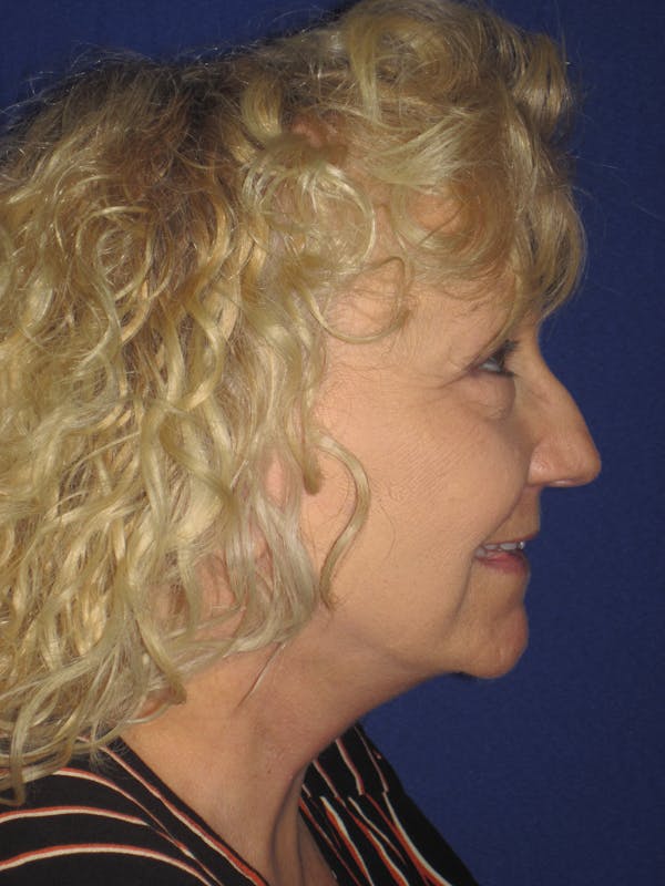 Facelift/Mini-Facelift Before & After Gallery - Patient 4890506 - Image 6