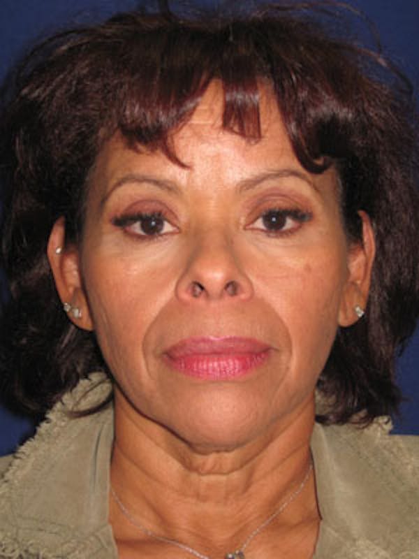 Facelift/Mini-Facelift Before & After Gallery - Patient 4890509 - Image 1