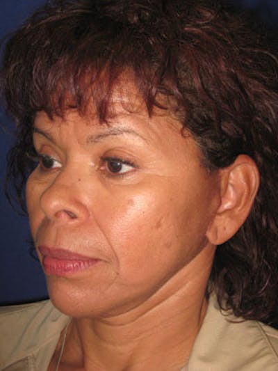 Facelift/Mini-Facelift Before & After Gallery - Patient 4890509 - Image 6