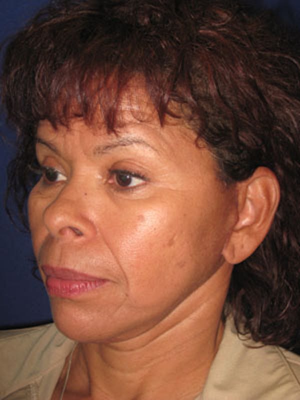 Facelift/Mini-Facelift Before & After Gallery - Patient 4890509 - Image 6