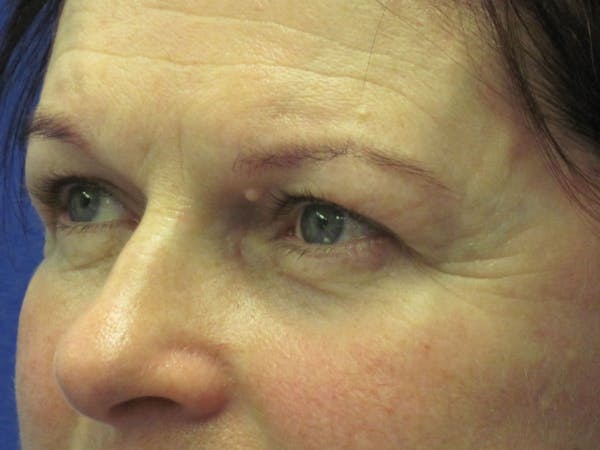 Browlift Before & After Gallery - Patient 4890520 - Image 1