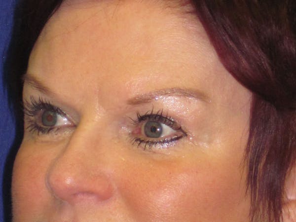 Browlift Before & After Gallery - Patient 4890520 - Image 2