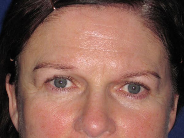 Browlift Before & After Gallery - Patient 4890520 - Image 3