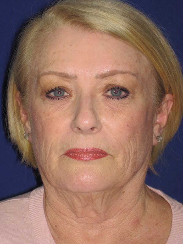 Facelift/Mini-Facelift Before & After Gallery - Patient 4890523 - Image 1