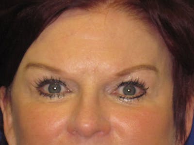 Browlift Before & After Gallery - Patient 4890520 - Image 4