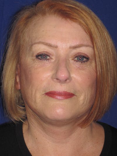 Facelift/Mini-Facelift Before & After Gallery - Patient 4890523 - Image 2