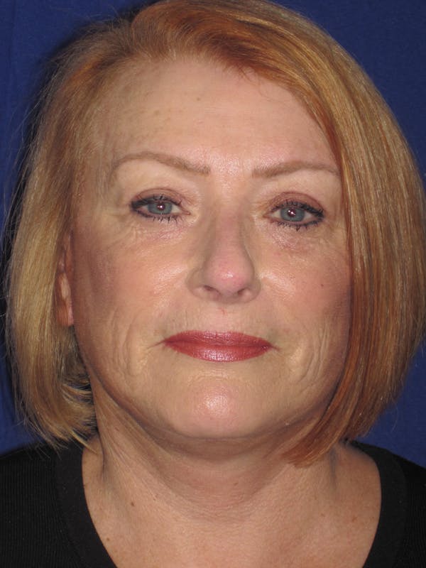 Facelift/Mini-Facelift Before & After Gallery - Patient 4890523 - Image 2