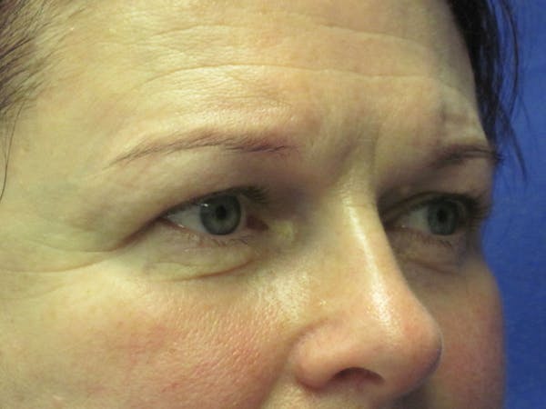 Browlift Before & After Gallery - Patient 4890520 - Image 5