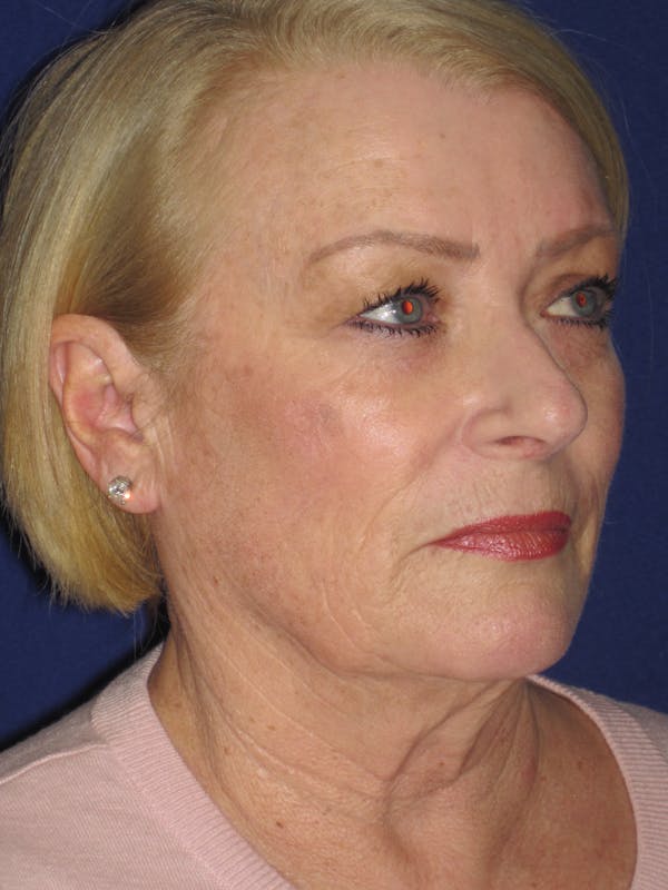 Facelift/Mini-Facelift Before & After Gallery - Patient 4890523 - Image 3