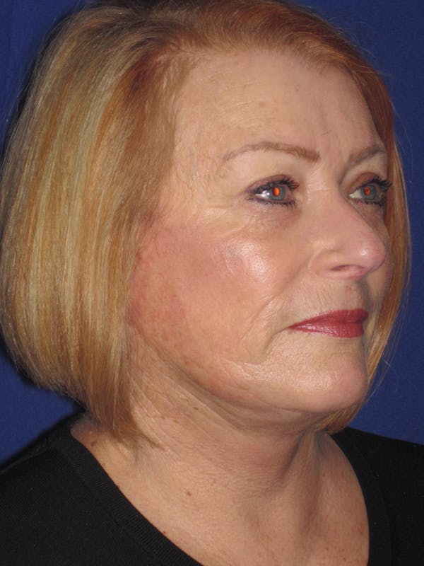 Facelift/Mini-Facelift Before & After Gallery - Patient 4890523 - Image 4