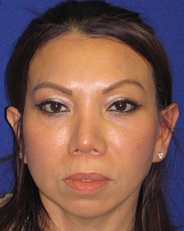 Browlift Before & After Gallery - Patient 4890521 - Image 2