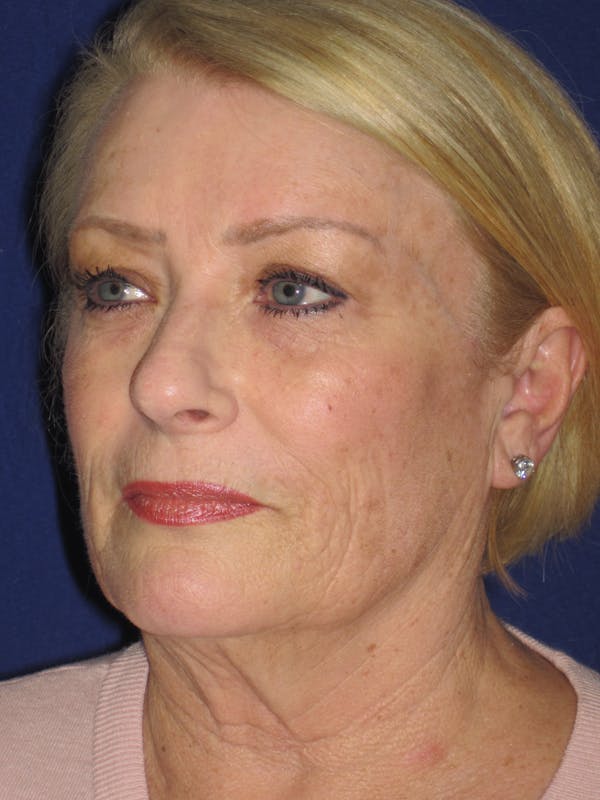 Facelift/Mini-Facelift Before & After Gallery - Patient 4890523 - Image 5