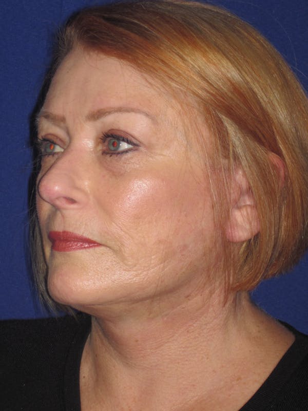 Facelift/Mini-Facelift Before & After Gallery - Patient 4890523 - Image 6