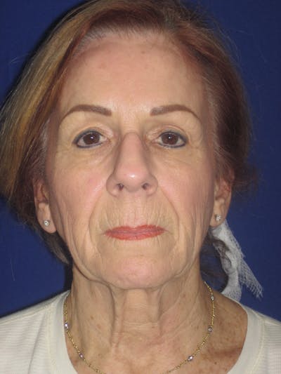 Facelift/Mini-Facelift Before & After Gallery - Patient 4890528 - Image 1