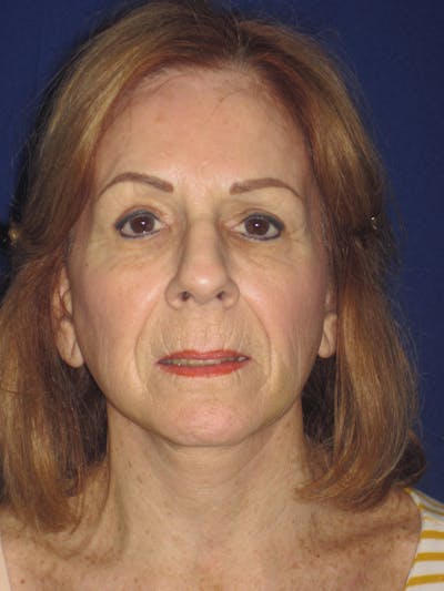 Facelift/Mini-Facelift Before & After Gallery - Patient 4890528 - Image 2