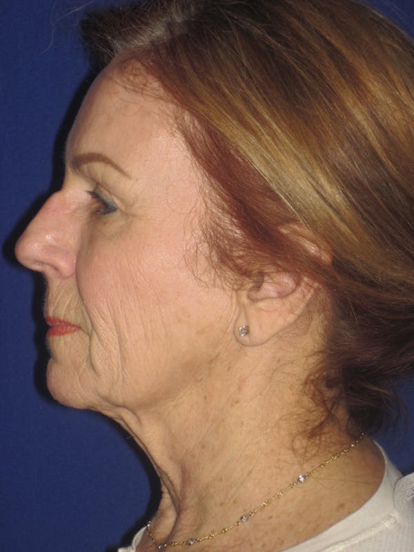 Facelift/Mini-Facelift Before & After Gallery - Patient 4890528 - Image 3