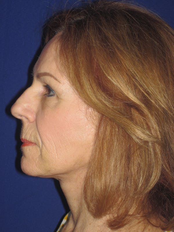 Facelift/Mini-Facelift Before & After Gallery - Patient 4890528 - Image 4