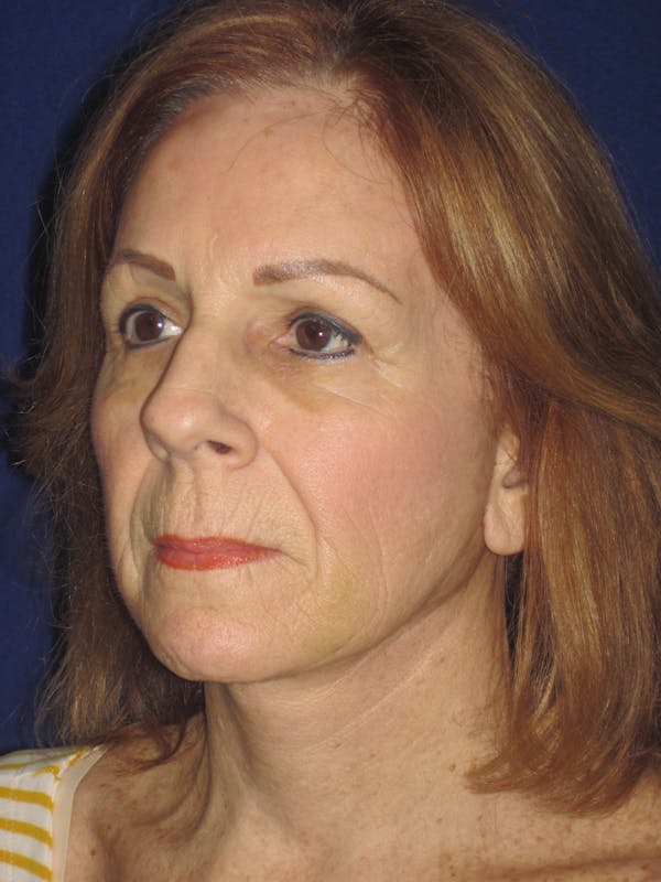 Facelift/Mini-Facelift Before & After Gallery - Patient 4890528 - Image 6
