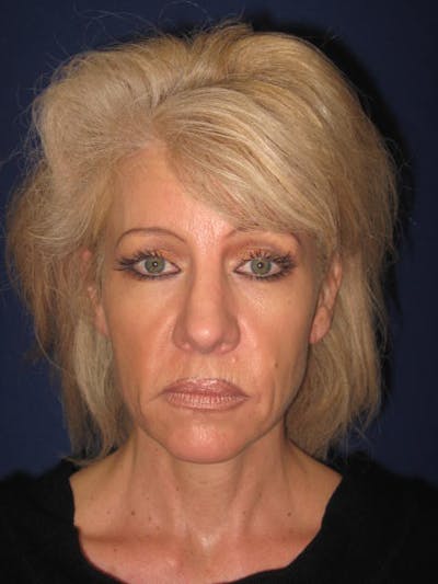 Facelift/Mini-Facelift Before & After Gallery - Patient 4890532 - Image 1