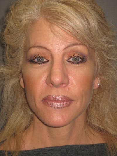 Facelift/Mini-Facelift Before & After Gallery - Patient 4890532 - Image 2