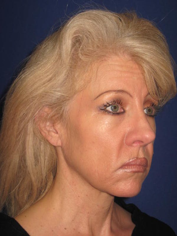 Facelift/Mini-Facelift Before & After Gallery - Patient 4890532 - Image 3