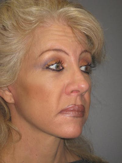Facelift/Mini-Facelift Before & After Gallery - Patient 4890532 - Image 4