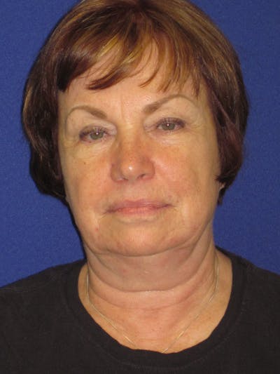 Facelift/Mini-Facelift Before & After Gallery - Patient 4890537 - Image 1