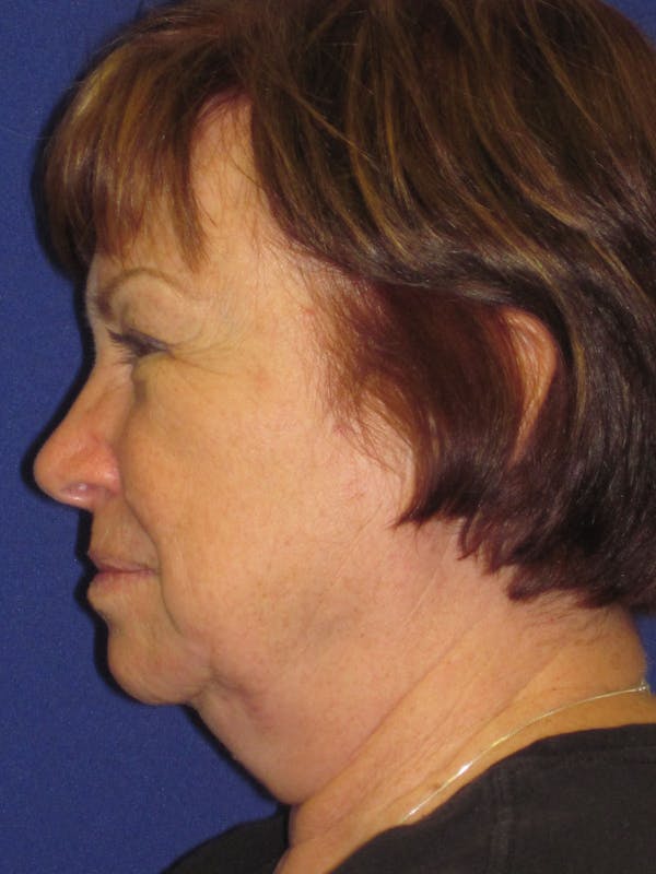 Facelift/Mini-Facelift Before & After Gallery - Patient 4890537 - Image 3