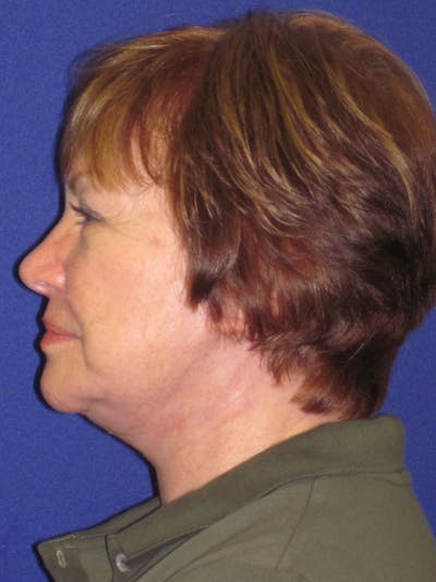 Facelift/Mini-Facelift Before & After Gallery - Patient 4890537 - Image 4